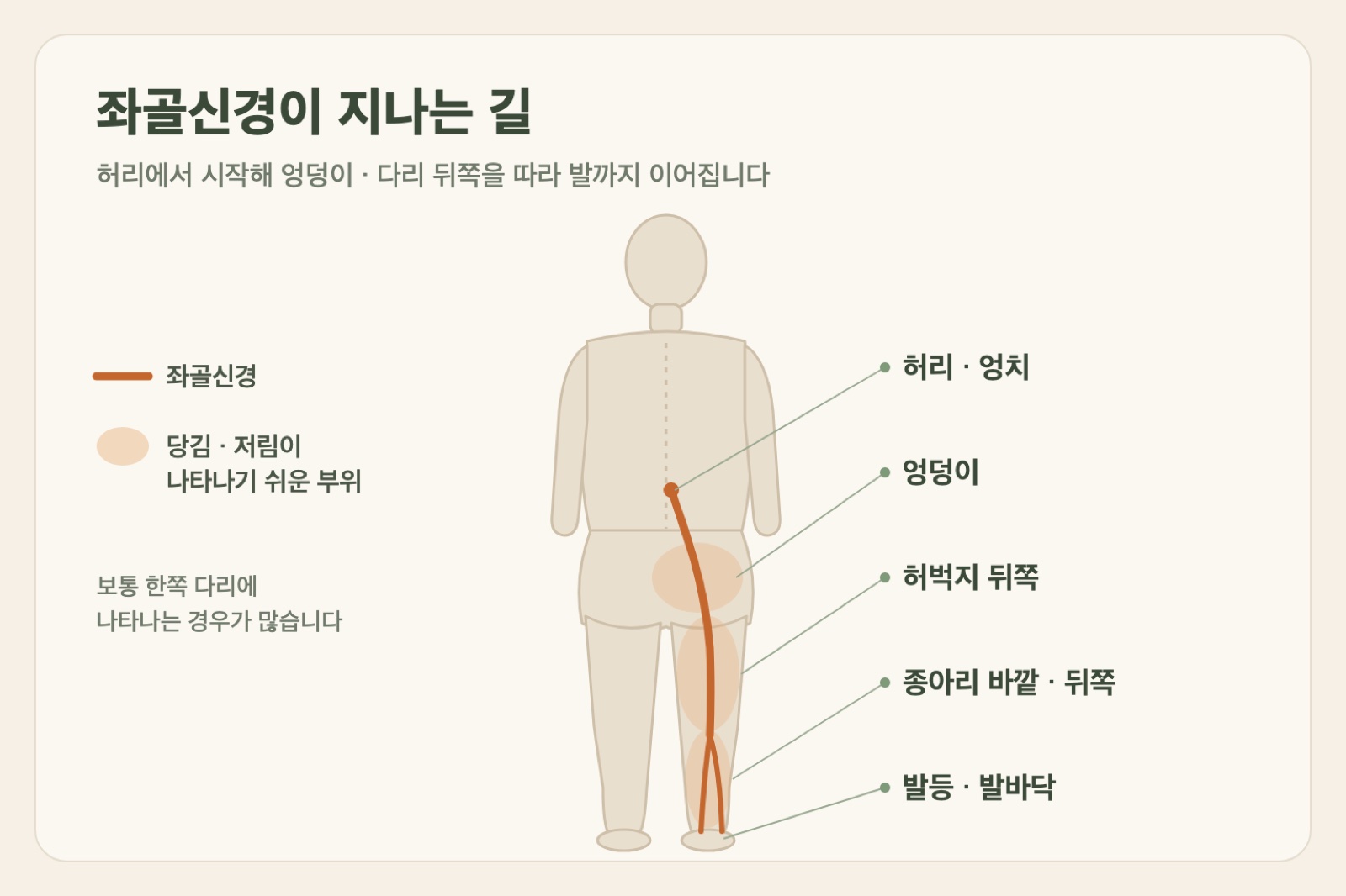 허리에서 엉덩이, 허벅지 뒤쪽, 종아리를 지나 발까지 이어지는 좌골신경 경로와 저림이 나타나기 쉬운 부위