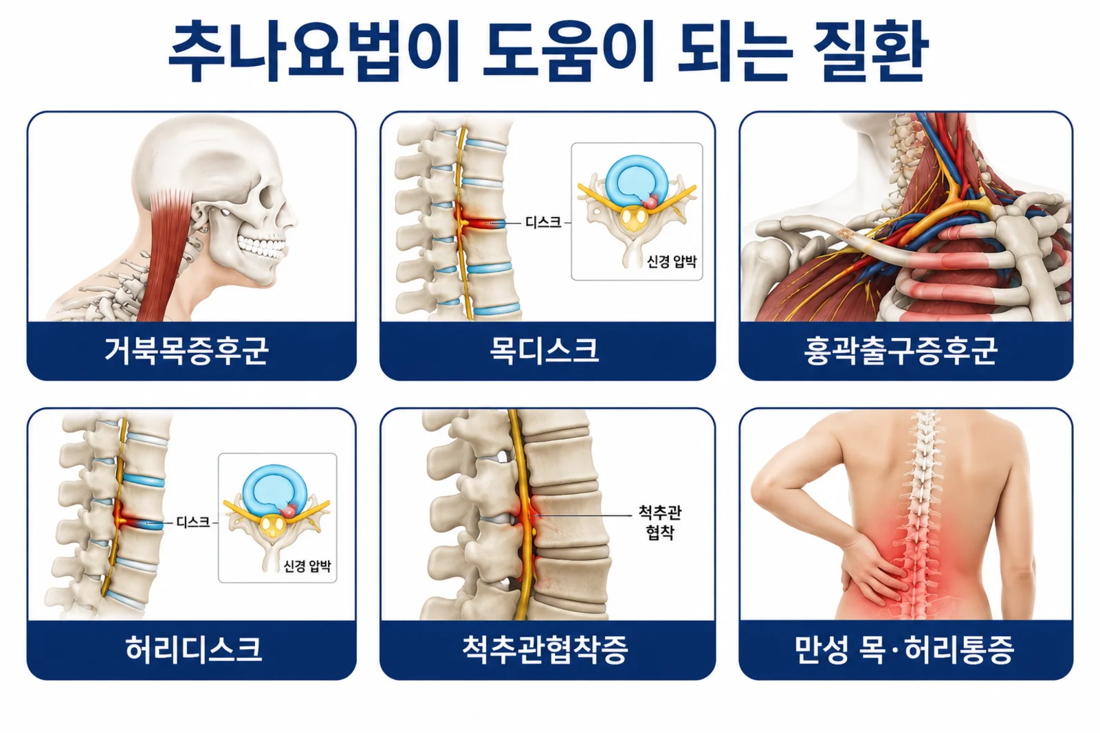 추나요법이 도움이 되는 질환 — 거북목증후군, 목디스크, 흉곽출구증후군, 허리디스크, 척추관협착증, 만성 목·허리통증