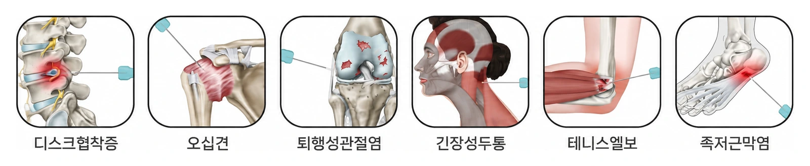 도침치료 활용 질환 — 디스크협착증, 오십견, 퇴행성관절염, 긴장성두통, 테니스엘보, 족저근막염