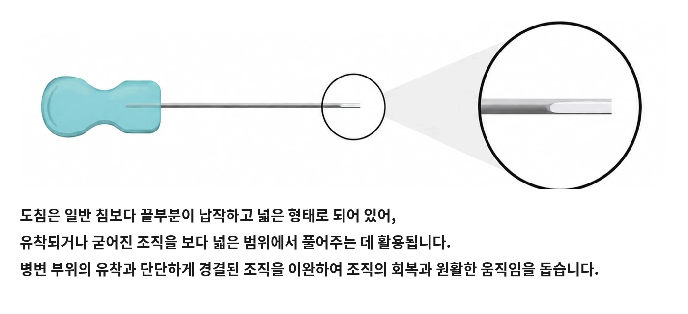 도침치료가 필요한 경우 — 뭉뚝한 침끝으로 넓은 부위 조직의 유착을 박리하는 도침 도해