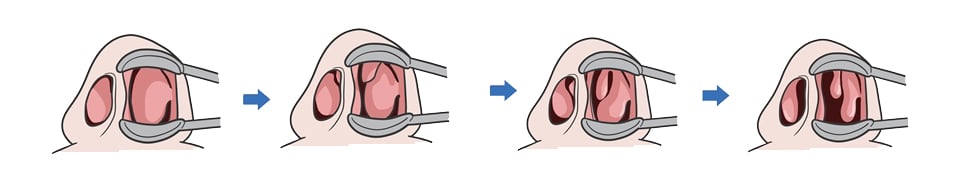 비강사혈(코침) 진행 과정 4단계 도식 — 부어 있는 비강 점막이 가라앉는 과정